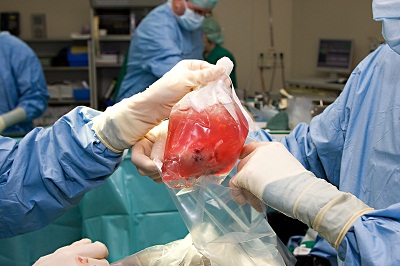 kidney transplant2.jpg